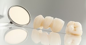Dental crown and bridge restorations before treatment