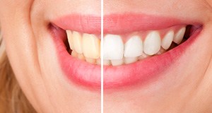 Closeup of smile half before and half after teeth whitening