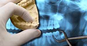 Model smile and x-rays of tooth to be removed