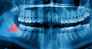 X-ray with impacted wisdom tooth highlighted red